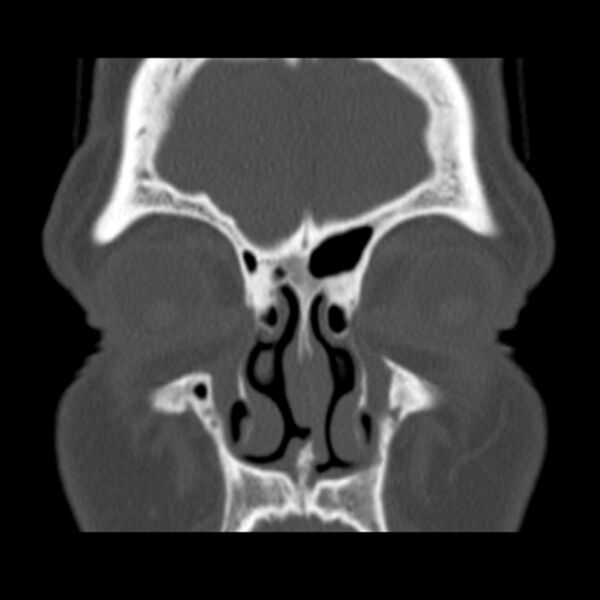 File:Nasolabial cyst (Radiopaedia 33987-35205 Coronal bone window 26).jpg