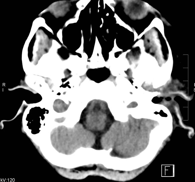 File:Necrotizing otitis externa (Radiopaedia 19938-19971 Axial non-contrast 5).jpg