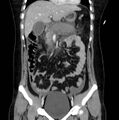 Necrotizing pancreatitis (Radiopaedia 23001-23031 B 26).jpg