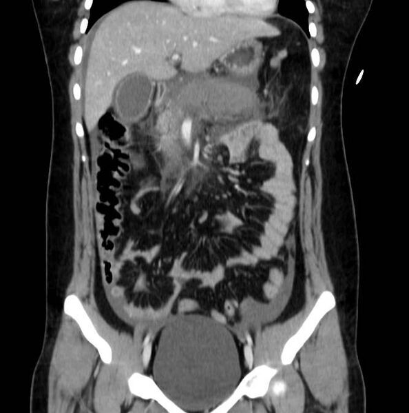 File:Necrotizing pancreatitis (Radiopaedia 23001-23031 B 26).jpg