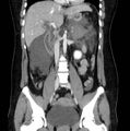 Necrotizing pancreatitis (Radiopaedia 23001-23031 B 35).jpg