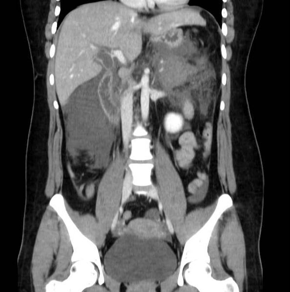 File:Necrotizing pancreatitis (Radiopaedia 23001-23031 B 35).jpg