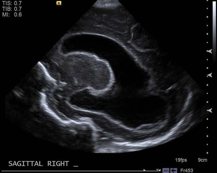File:Neonatal intracranial hemorrhage - grade 3 (Radiopaedia 27279-27455 Longitudinal 5).jpg