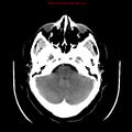 Neuroglial cyst (Radiopaedia 10713-11185 Axial non-contrast 25).jpg