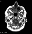 Neurosarcoidosis (Radiopaedia 10930-11351 Axial T1 1).jpg