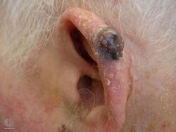 Nodular melanoma (DermNet NZ nm7-big).jpg
