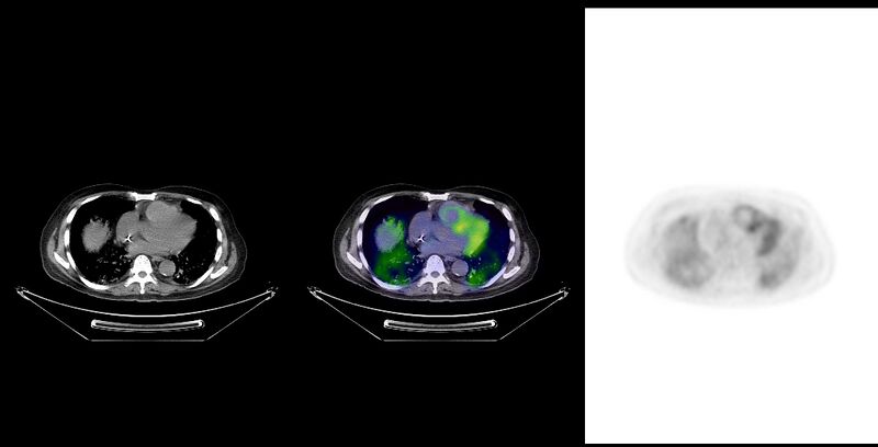 File:Non-Hodgkin lymphoma involving seminal vesicles with development of interstitial pneumonitis during Rituximab therapy (Radiopaedia 32703-33761 ax CT Fus PET 20).jpg