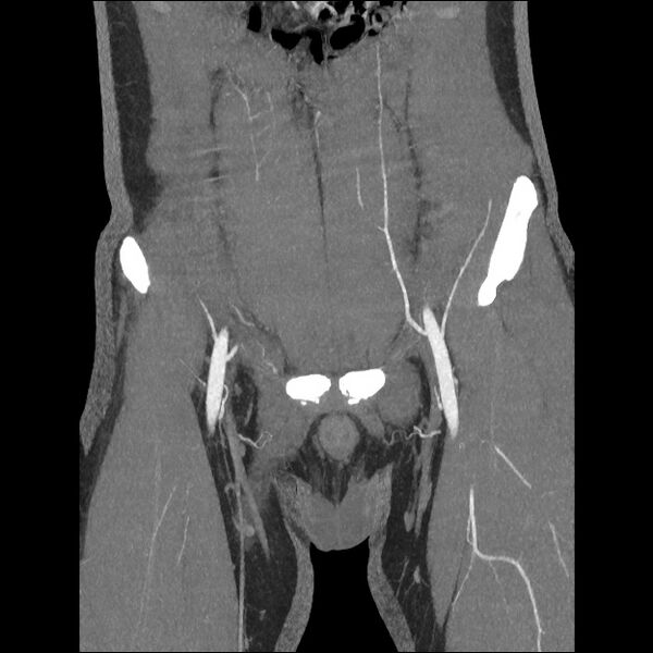 File:Normal CT angiogram of pelvis (Radiopaedia 45390-49430 B 15).jpg