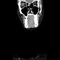 Normal CT of the neck (Radiopaedia 14575-14500 Coronal C+ 10).jpg