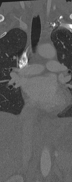 File:Normal CT thoracic spine (Radiopaedia 40181-42688 Coronal bone window 10).png
