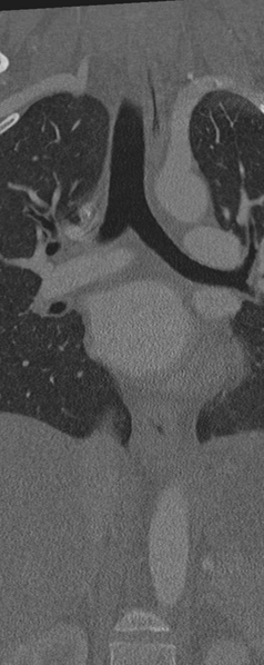 File:Normal CT thoracic spine (Radiopaedia 40181-42688 Coronal bone window 15).png