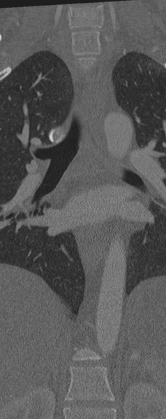 File:Normal CT thoracic spine (Radiopaedia 40181-42688 Coronal bone window 20).png