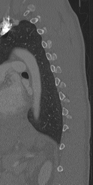 File:Normal CT thoracic spine (Radiopaedia 40181-42688 Sagittal bone window 14).png