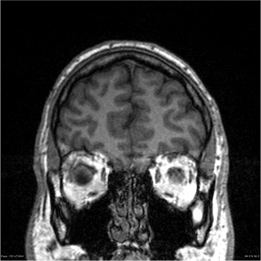 Normal brain MRI (non-focal epilepsy protocol) (Radiopaedia 38571-40700 Coronal T1 87).jpg
