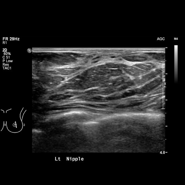 File:Normal breast mammography (tomosynthesis) and ultrasound (Radiopaedia 65325-74354 Left breast 14).jpeg