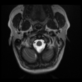 Normal cervical and thoracic spine MRI (Radiopaedia 35630-37156 Axial T2 32).png