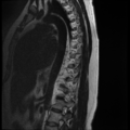 Normal cervical and thoracic spine MRI (Radiopaedia 35630-37156 G 2).png