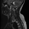 Normal cervical and thoracic spine MRI (Radiopaedia 35630-37156 Sagittal T2 12).png