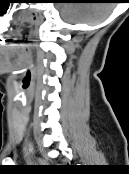 File:Normal cervical spine MRI (including Dixon) (Radiopaedia 42762-45926 C 21).png