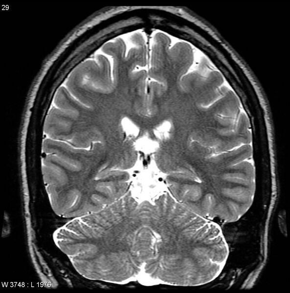 File:Normal coronal brain (Radiopaedia 6676-7910 Coronal T2 29).jpg
