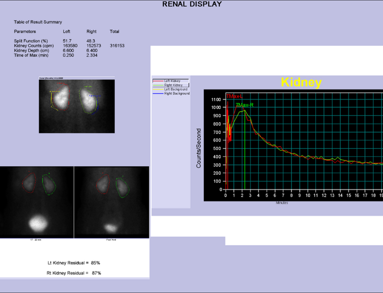 File:Normal dynamic renal scintigraphy (Radiopaedia 91103-108671 B 1).png
