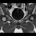 Normal prostate (MRI) (Radiopaedia 29986-30535 Coronal T1 3).jpg