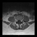 Normal spine MRI (Radiopaedia 77323-89408 Axial T1 13).jpg