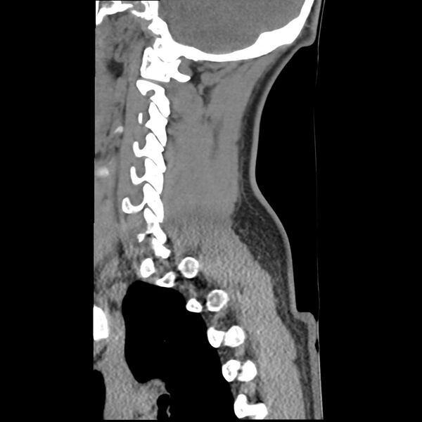 File:Normal trauma spine imaging (Radiopaedia 31753-32686 A 9).jpg