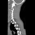 Normal trauma spine imaging (age 16) (Radiopaedia 45335-49358 C 8).jpg