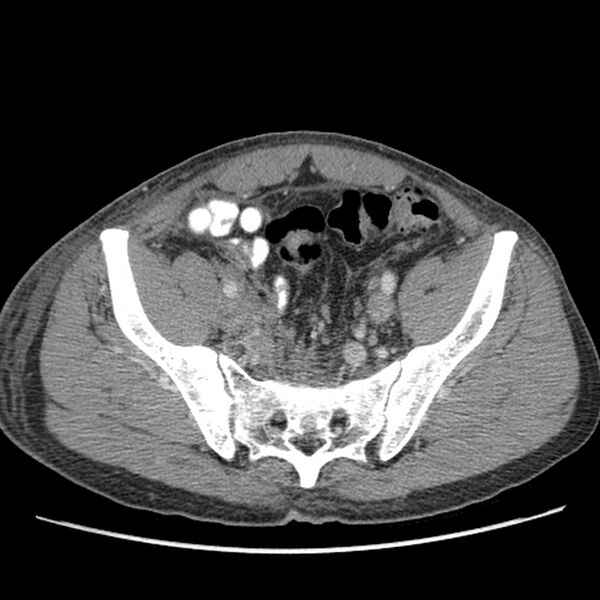 File:Obstructive bladder transitional cell carcinoma (Radiopaedia 9825-10410 A 25).jpg