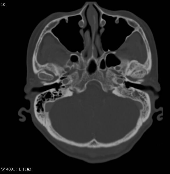 File:Occipital condyle metastasis - into mastoid (Radiopaedia 5424-7177 Axial bone window 10).jpg