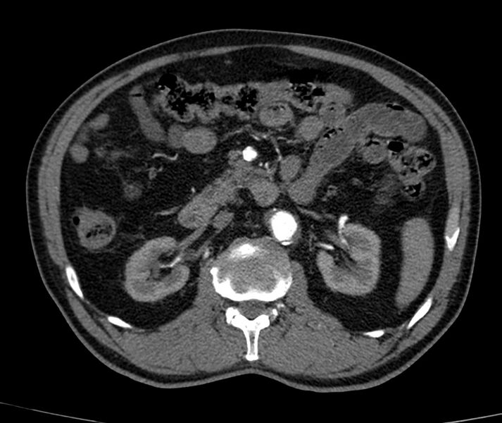 File:Abdominal aortic aneurysm (Radiopaedia 22421-22458 C+ arterial phase 32).jpg