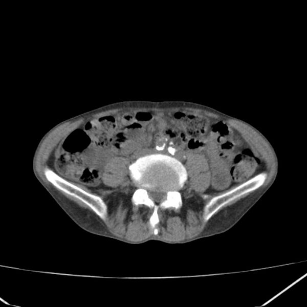 File:Abdominal aortic aneurysm (Radiopaedia 23703-23856 Axial non-contrast 34).jpg