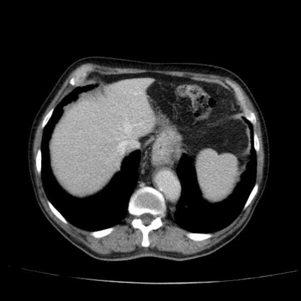 File:Abdominal aortic aneurysm (Radiopaedia 29248-29660 Axial C+ portal venous phase 11).jpg