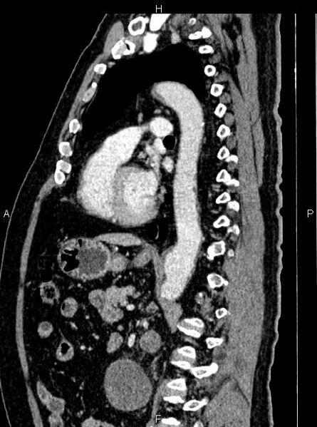 File:Abdominal aortic aneurysm (Radiopaedia 83094-97462 Sagittal renal cortical phase 74).jpg