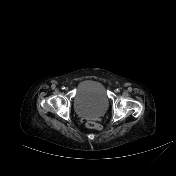 File:Abdominal aortic aneurysm - impending rupture (Radiopaedia 19233-19246 Axial non-contrast 120).jpg