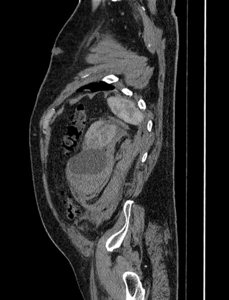 File:Abdominal aortic aneurysm rupture (Radiopaedia 54179-60362 Sagittal C+ arterial phase 40).jpg