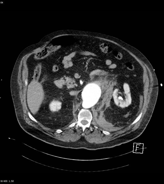 File:Abdominal aortic aneurysm with intramural hematoma then rupture (Radiopaedia 50278-55632 Axial C+ arterial phase 63).jpg