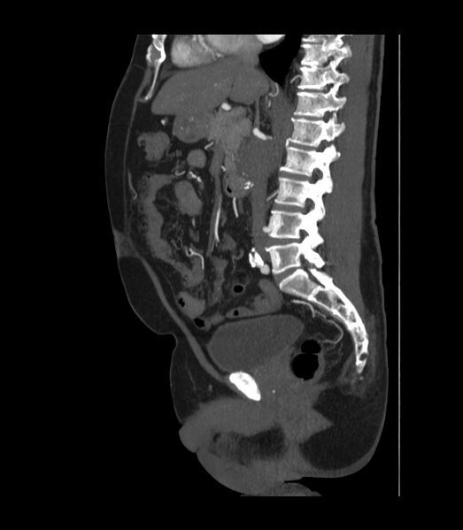File:Abdominal aortic aneurysm with thrombus fissuration (Radiopaedia 46218-50618 Sagittal C+ arterial phase 28).jpg