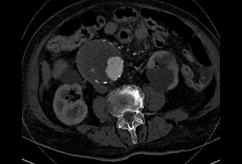 Abdominal aortic aneurysm with thrombus fissuration (Radiopaedia 73192-83919 Axial C+ arterial phase 108).jpg