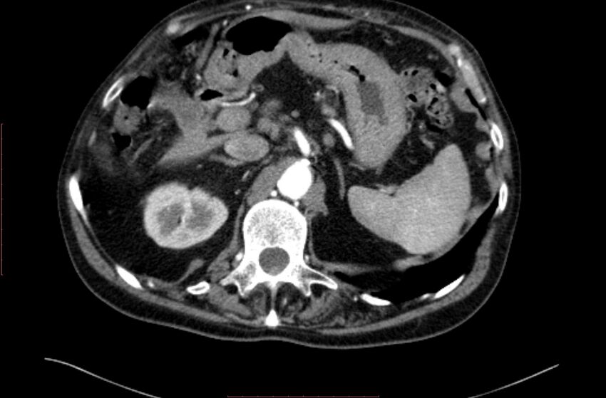Abdominal aortic interposition tube graft and aneurysm thrombosis (Radiopaedia 71438-81857 Axial C+ arterial phase 17).jpg
