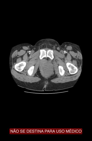 File:Abdominal desmoid tumor (Radiopaedia 44024-47540 Axial C+ arterial phase 57).jpg