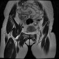 Abdominal wall endometriosis (Radiopaedia 83702-98847 Coronal T2 3).jpg
