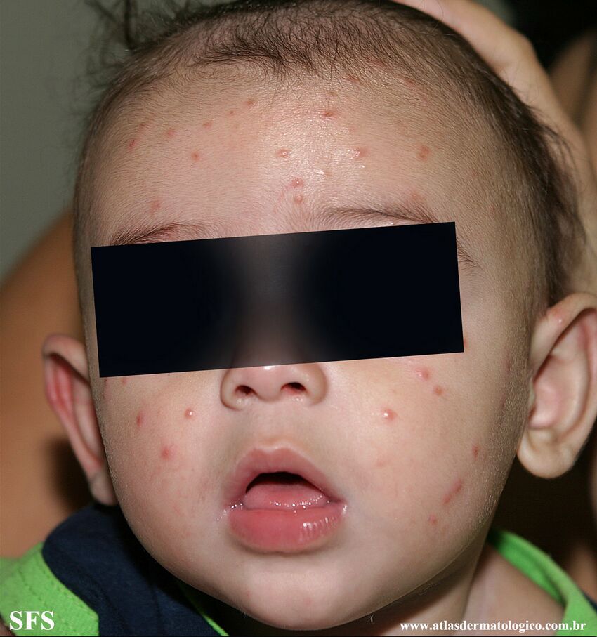Acrodermatitis Infantile Papular (Dermatology Atlas 36).jpg