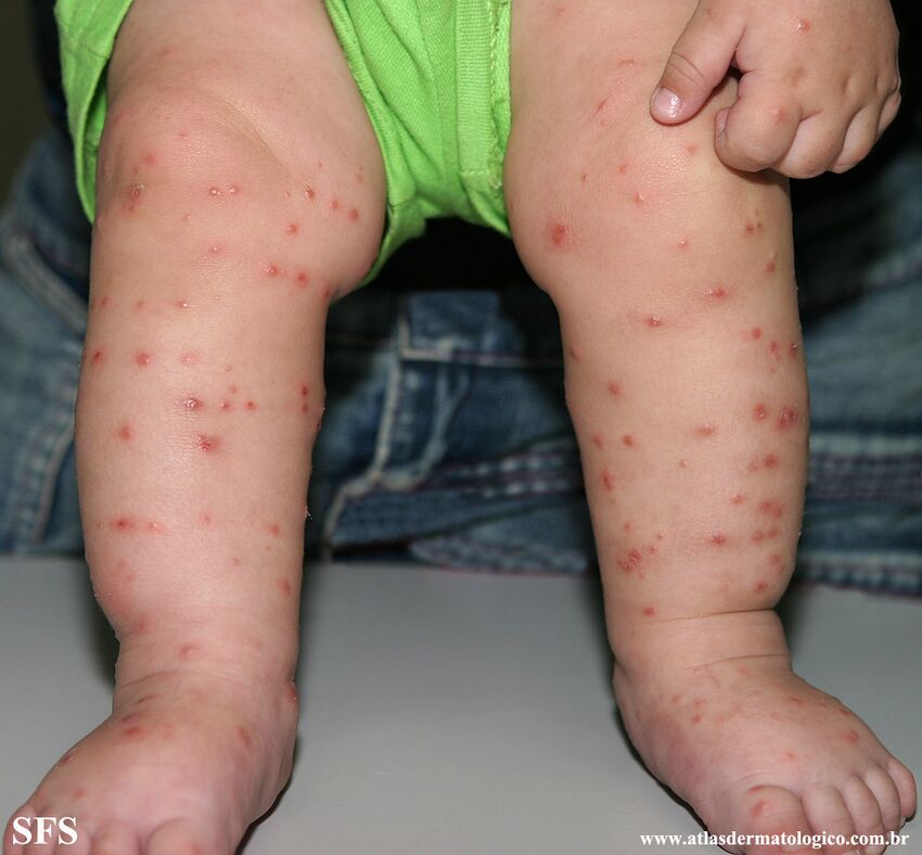 Acrodermatitis Infantile Papular (Dermatology Atlas 39).jpg