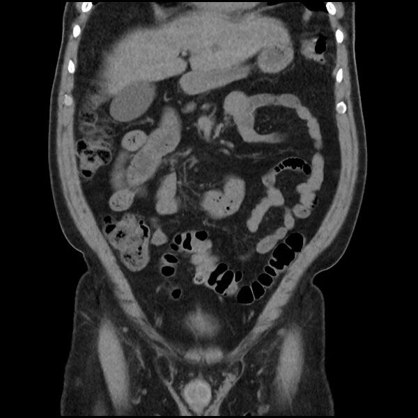 File:Active colonic bleed on CT (Radiopaedia 49765-55025 Coronal non-contrast 19).jpg