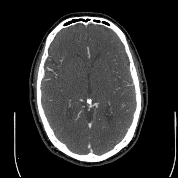 File:Acute A3 occlusion with ACA ischemic penumbra (CT perfusion) (Radiopaedia 72036-82527 Axial C+ arterial phase thins 75).jpg