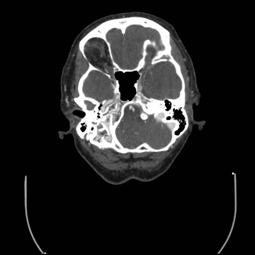 Acute M1 occlusion with ischemic penumbra (CT perfusion) (Radiopaedia 71897-82344 Axial C+ arterial phase thins 124).jpg