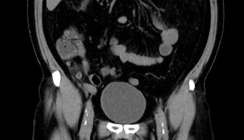 File:Acute appendicitis (Radiopaedia 13030-13091 Coronal non-contrast 7).jpg