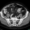 Acute appendicitis arising from a malrotated cecum (Radiopaedia 19970-19997 Axial C+ portal venous phase 33).jpg